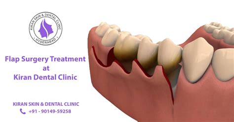 laser flap surgery dental cost in hyderabad